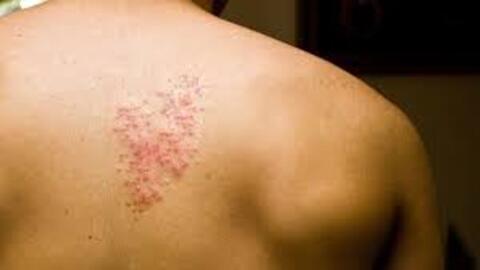 Người lớn có bệnh lý mạn tính lo ngại zona làm giảm chất lượng cuộc sống