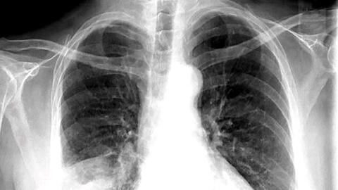 Hướng dẫn chẩn đoán và điều trị viêm phổi mắc phải cộng đồng ở người lớn