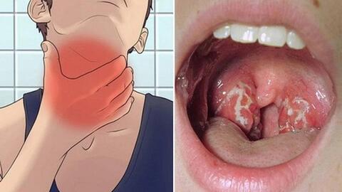 Tăng cường công tác chẩn đoán, điều trị bệnh bạch hầu