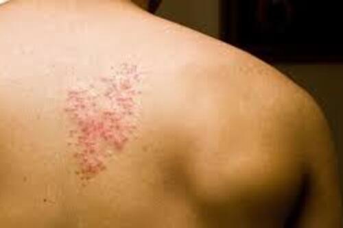 Người lớn có bệnh lý mạn tính lo ngại zona làm giảm chất lượng cuộc sống