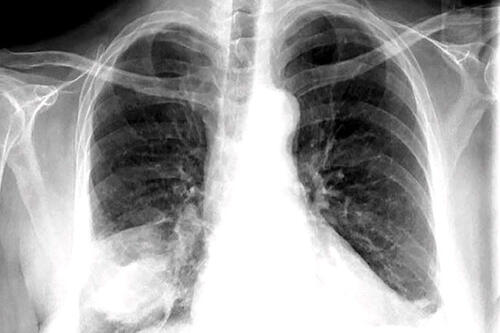 Hướng dẫn chẩn đoán và điều trị viêm phổi mắc phải cộng đồng ở người lớn