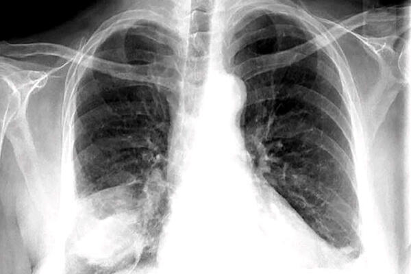 Hướng dẫn chẩn đoán và điều trị viêm phổi mắc phải cộng đồng ở người lớn